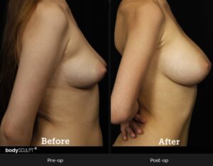 Breast Augmentation - Patient 2 Before & After Photos