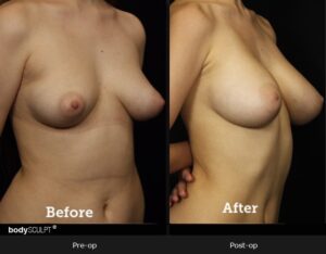 Breast Augmentation - Patient 2 Before & After Photos