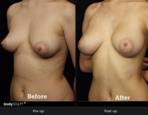 Breast Augmentation - Patient 2 Before & After Photos