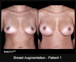 Breast Augmentation