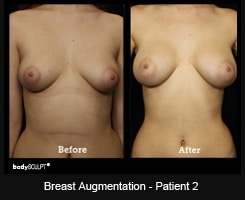 Breast Augmentation