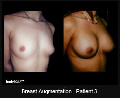 Breast Augmentation