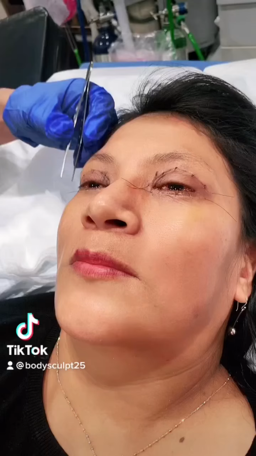 One Week Post-op 4-Lid Blepharoplasty Patient