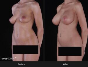 Composite Breast Augmentation - Patient 1