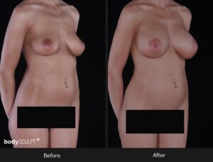 Composite Breast Augmentation - Patient 1