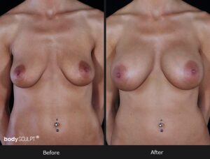 Composite Breast Augmentation - Patient 1