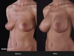 Composite Breast Augmentation - Patient 1
