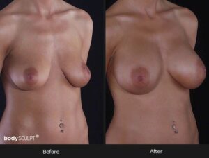 Composite Breast Augmentation - Patient 1