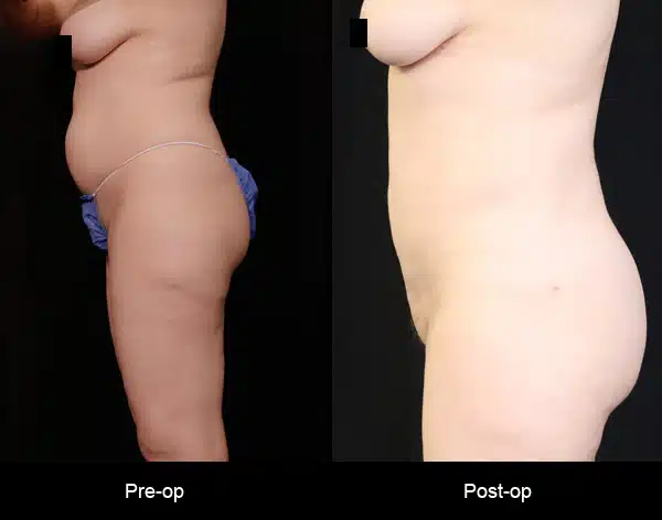 BodyTite - Before & After Photos