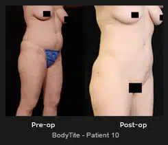 BodyTite - Before & After Photos