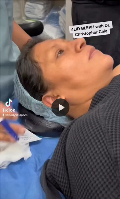 4 Lid Blepharoplasty: Before and After Videos