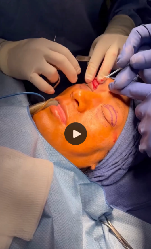 Blepharoplasty - Patient 2