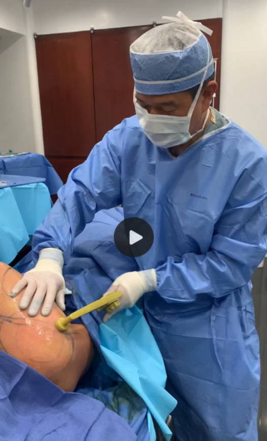 BodyTite Arm Liposuction