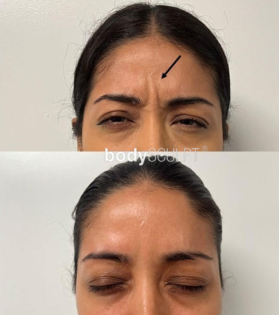 Botox® Before & After Photos
