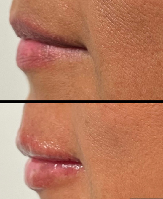Botox and Lip Filler Treatments - Before and After Photos