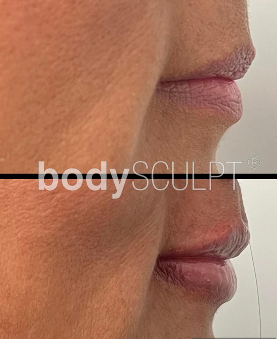 Botox and Lip Filler Treatments - Before and After Photos