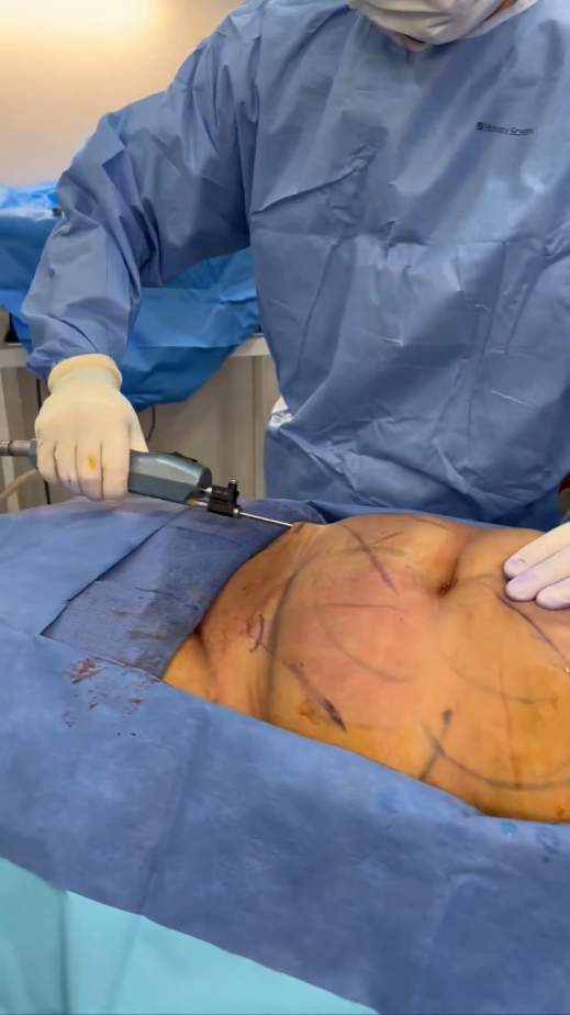 VASER Liposuction for Abdomen Contouring