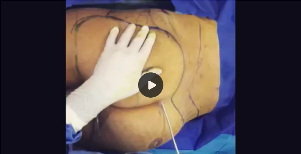 Brazilian Butt Lift Surgery Video: Patient 2