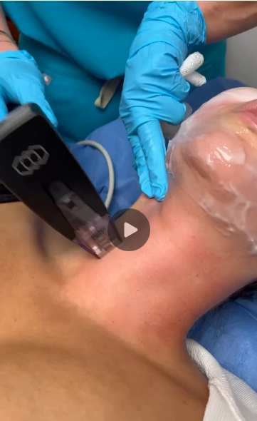 Morpheus8 Full Face/Neck Procedure