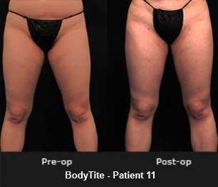 BodyTite Patient 11