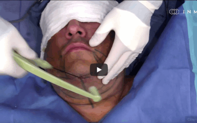 Educational Series – FaceTite + Morpheus8 with Chris Chia, MD