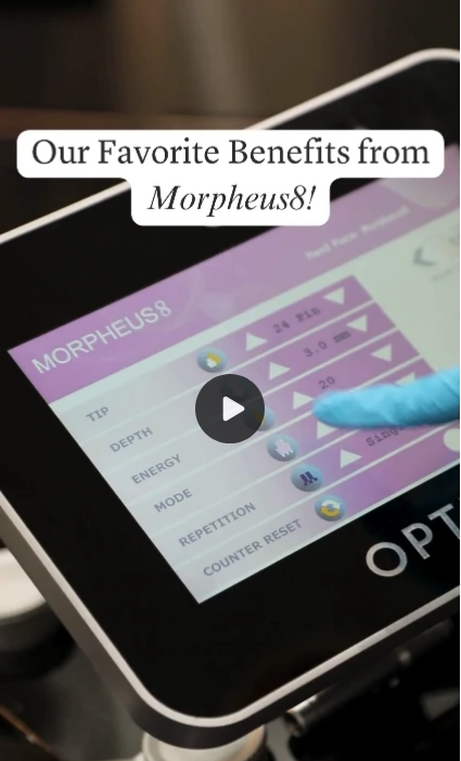 Morpheus8 Treatment for Face - Patient 4