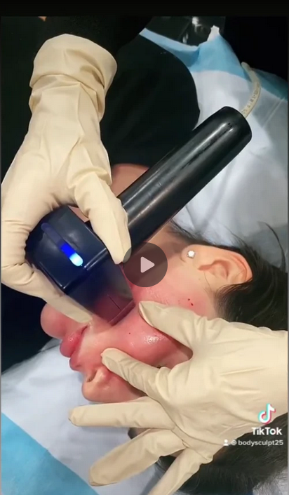Morpheus8 Treatment for Face - Patient 2