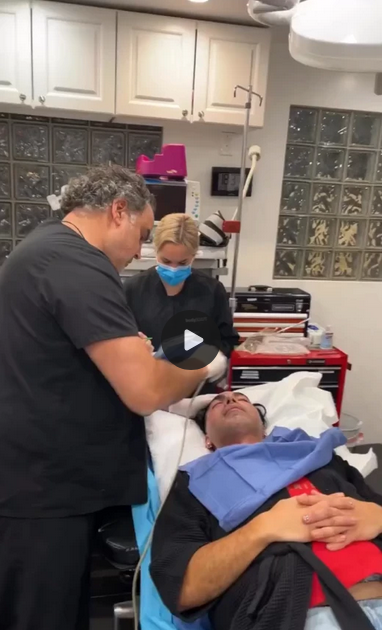 Morpheus8 Treatment for Face - Patient 3
