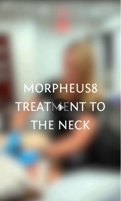 Neck Rejuvenation with Morpheus8 - Patient 4