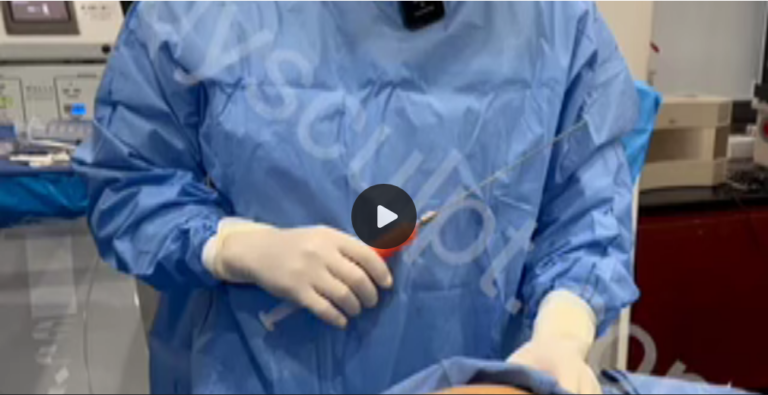 Brazilian Butt Lift under Local Anesthesia (BBLULA) - Video