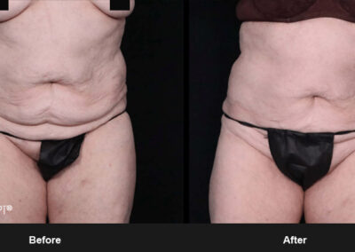 Ab Contour with MORPHEUS8