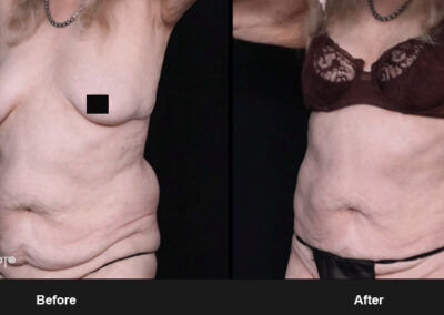 Ab Contour with MORPHEUS8