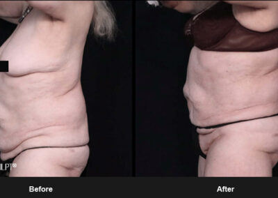 Ab Contour with MORPHEUS8