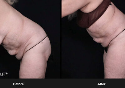 Ab Contour with MORPHEUS8