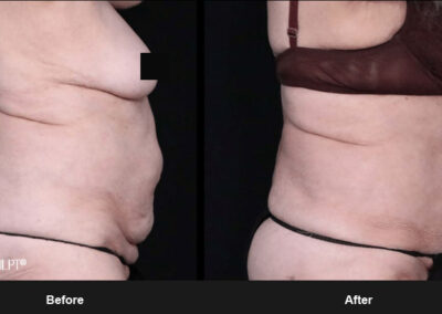 Ab Contour with MORPHEUS8