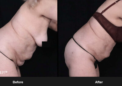 Ab Contour with MORPHEUS8