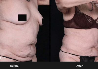 Ab Contour with MORPHEUS8