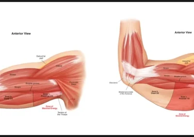 Female Armlift