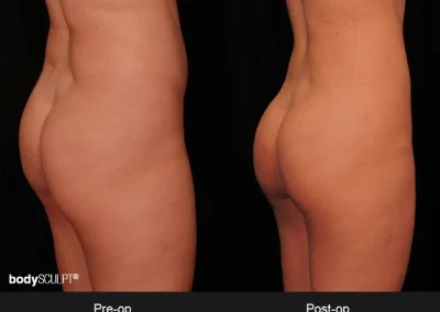 Brazilian Butt Lift - Before & After Photos