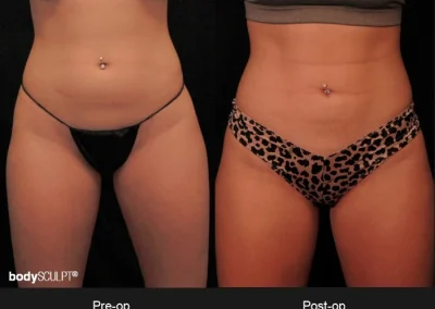 BodyTite Liposuction for Women - Before & After Photos