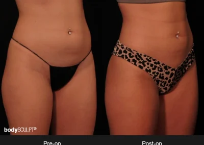 BodyTite Abdomen – Before & After Photos