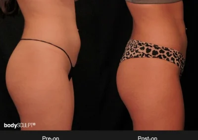 BodyTite Abdomen – Before & After Photos
