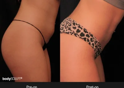 BodyTite Abdomen – Before & After Photos