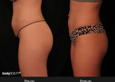 BodyTite Abdomen – Before & After Photos