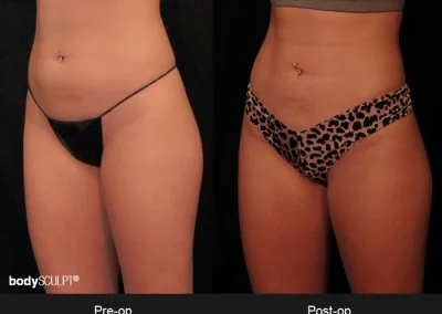BodyTite Abdomen – Before & After Photos