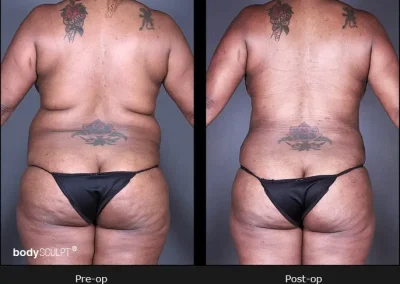 BodyTite Liposuction