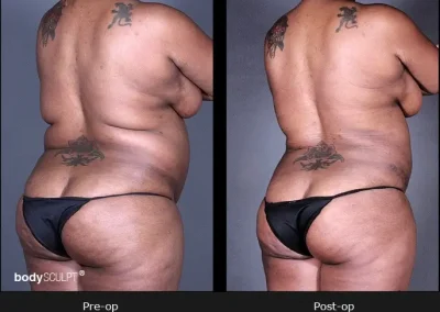 BodyTite Liposuction