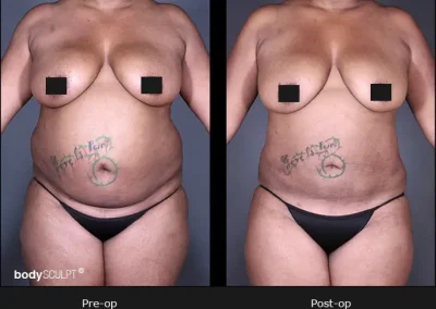 BodyTite Liposuction