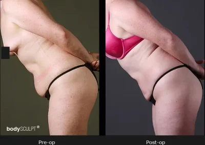 BodyTite Liposuction Surgery – Before & After Photos