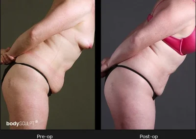 BodyTite Liposuction for Women - Before & After Photos